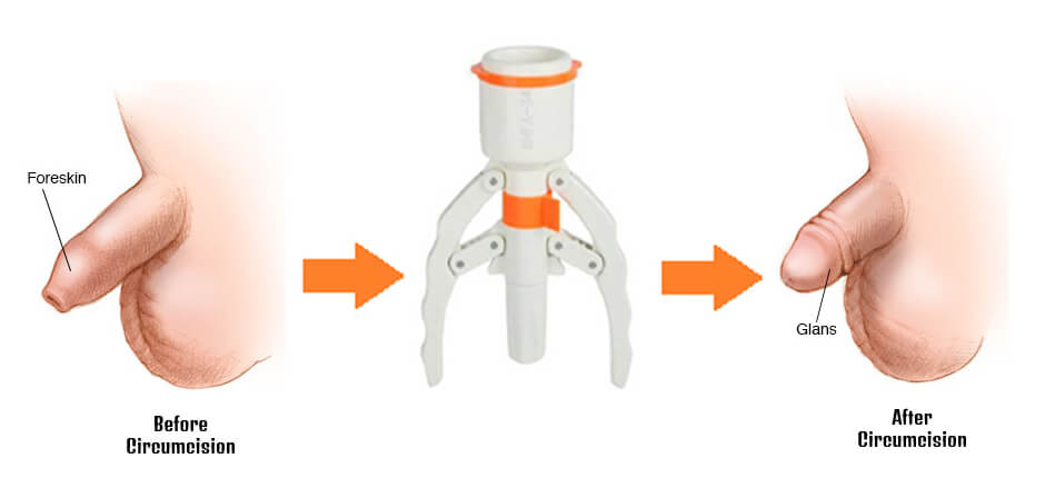 Stapler Circumcision